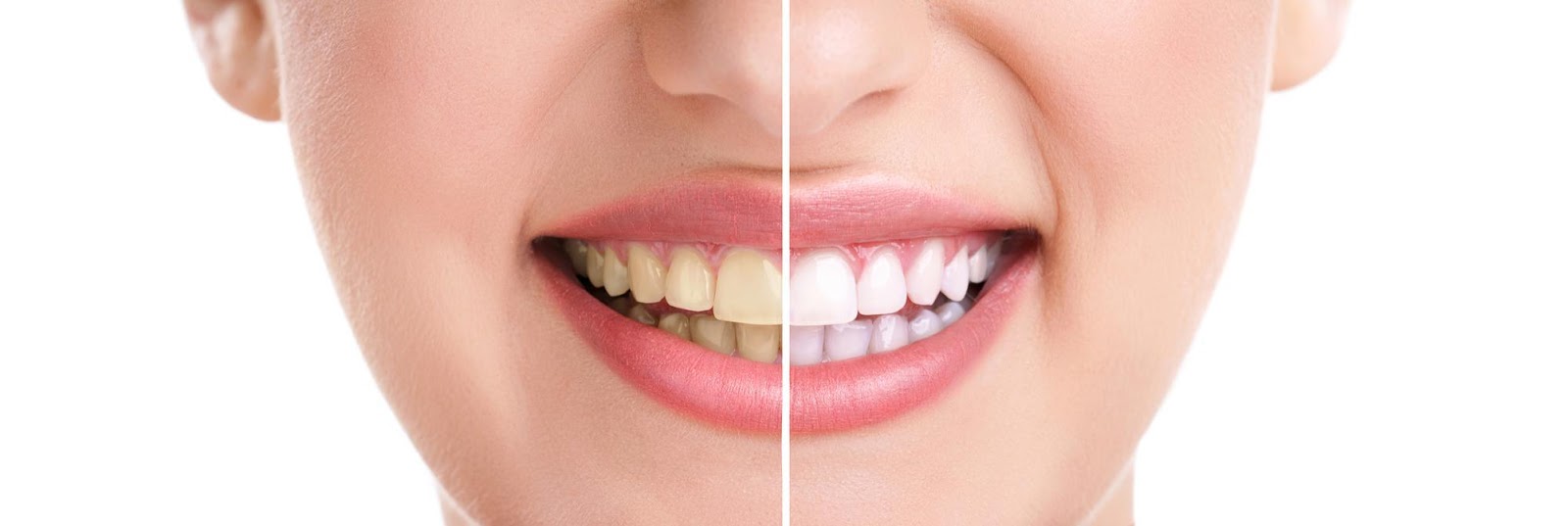 Is There a Link Between UV Light Teeth Whitening and Cancer