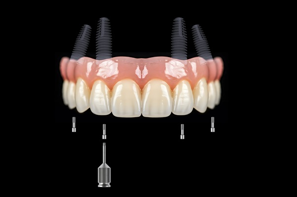 Can All On   Replace Multiple Teeth?