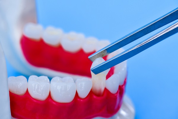 How Dental Implants Can Change Your Smile